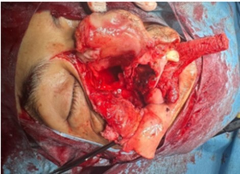 First paralateronasal route.